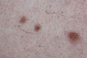 Перехідні невуси