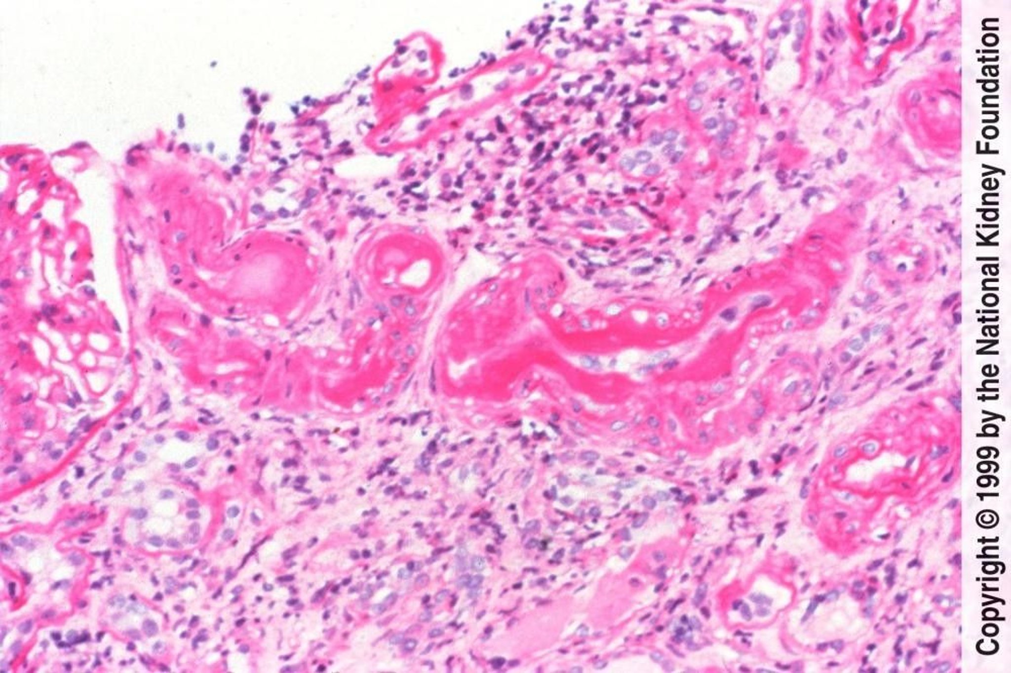 Benign Hypertensive Arteriolar Nephrosclerosis