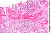 Néphrosclérose hypertensive artériolaire bénigne