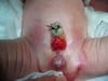 Extrofia vesical