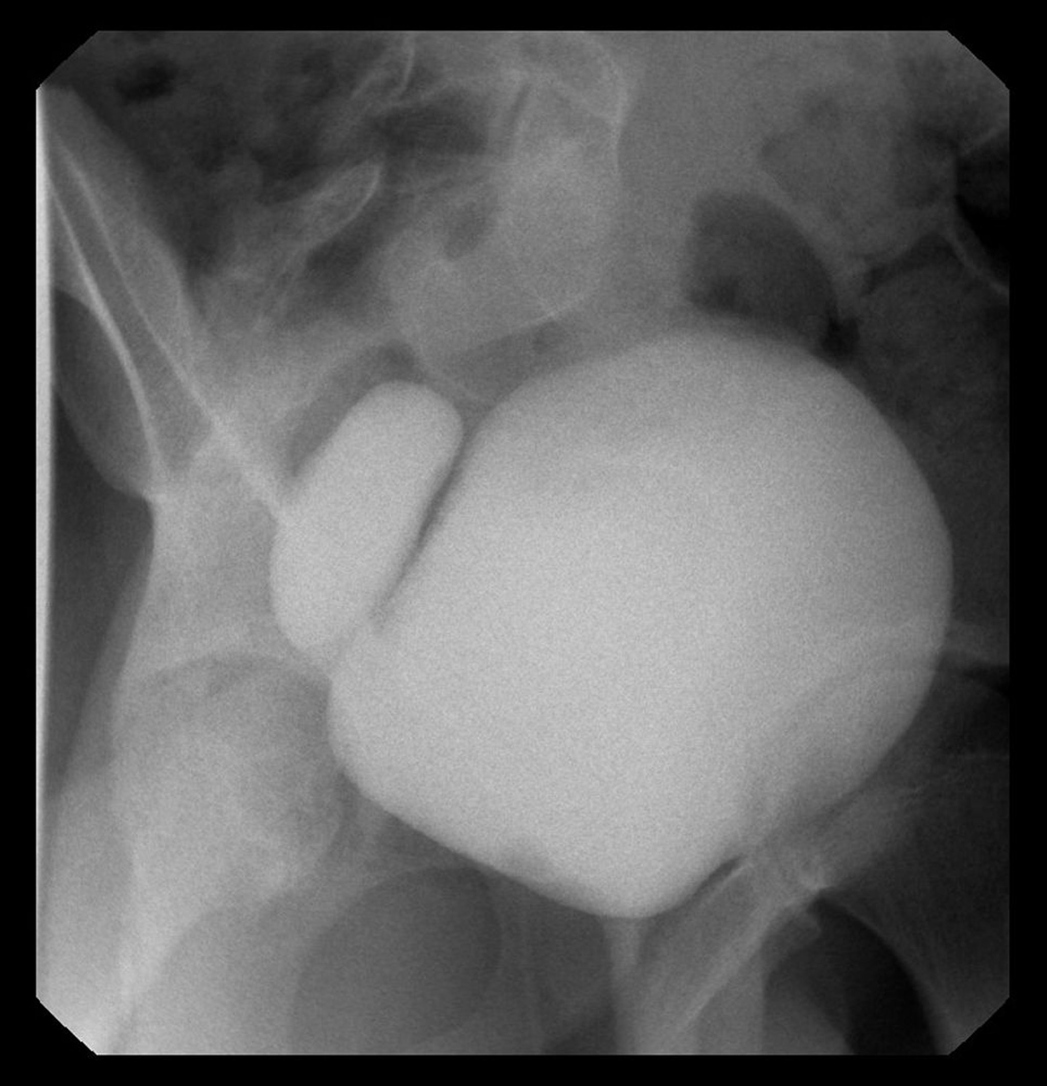 Divertículo vesical