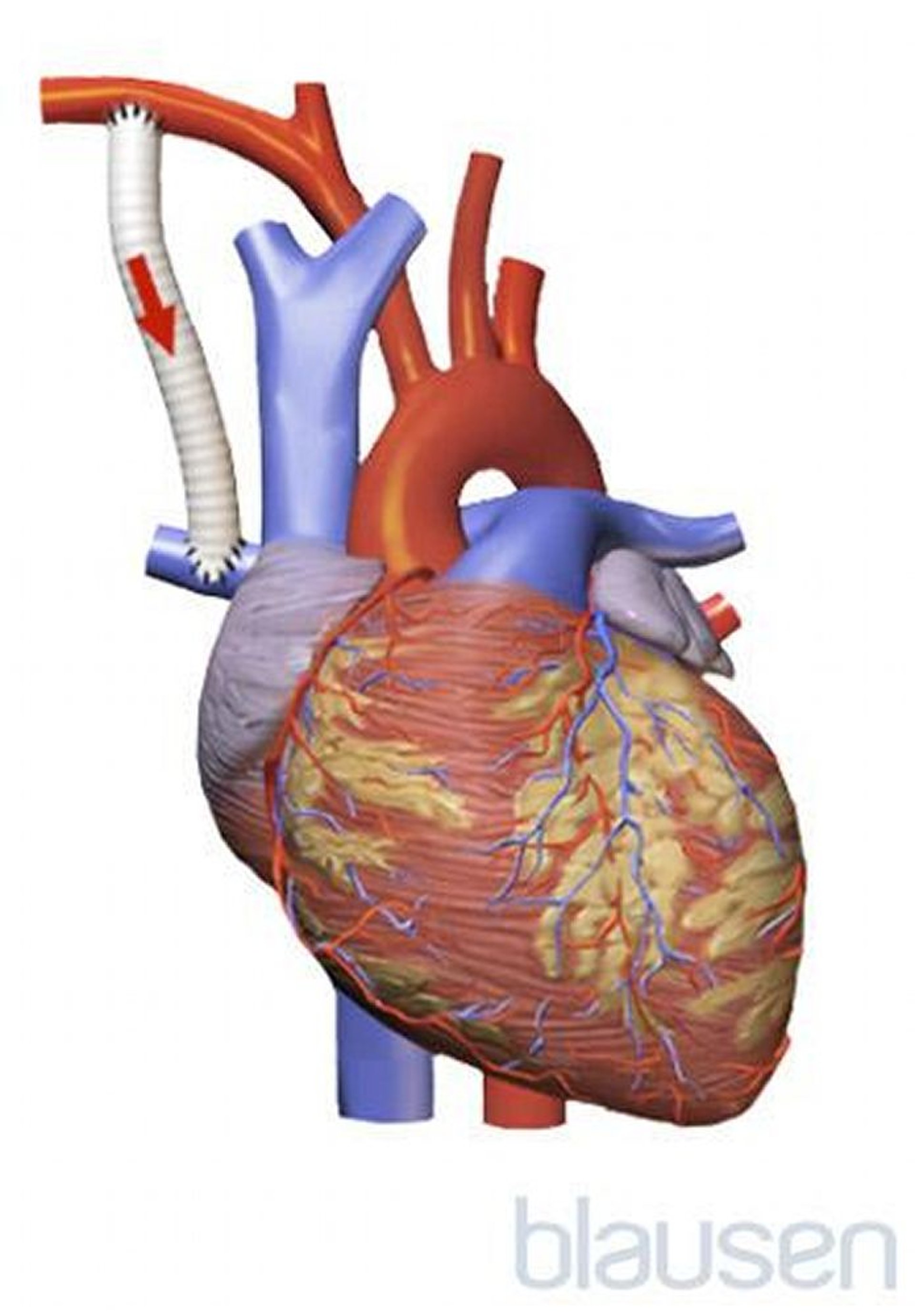Shunt di Blalock-Taussig-Thomas modificato