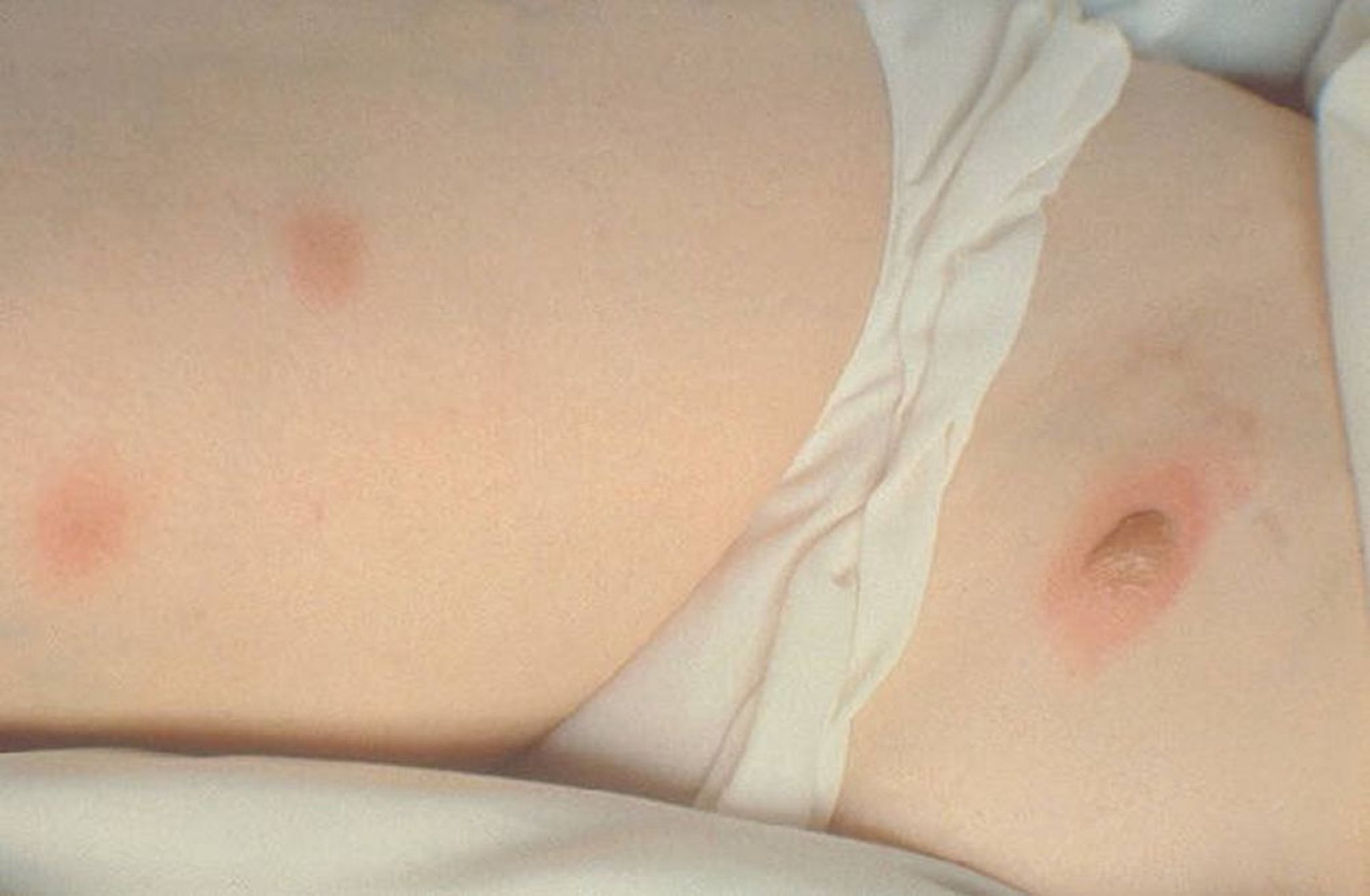 Extrapulmonale Blastomykose (Bullae)