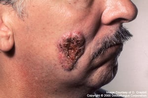 Extrapulmonale Blastomykose (Verruköses Aussehen)