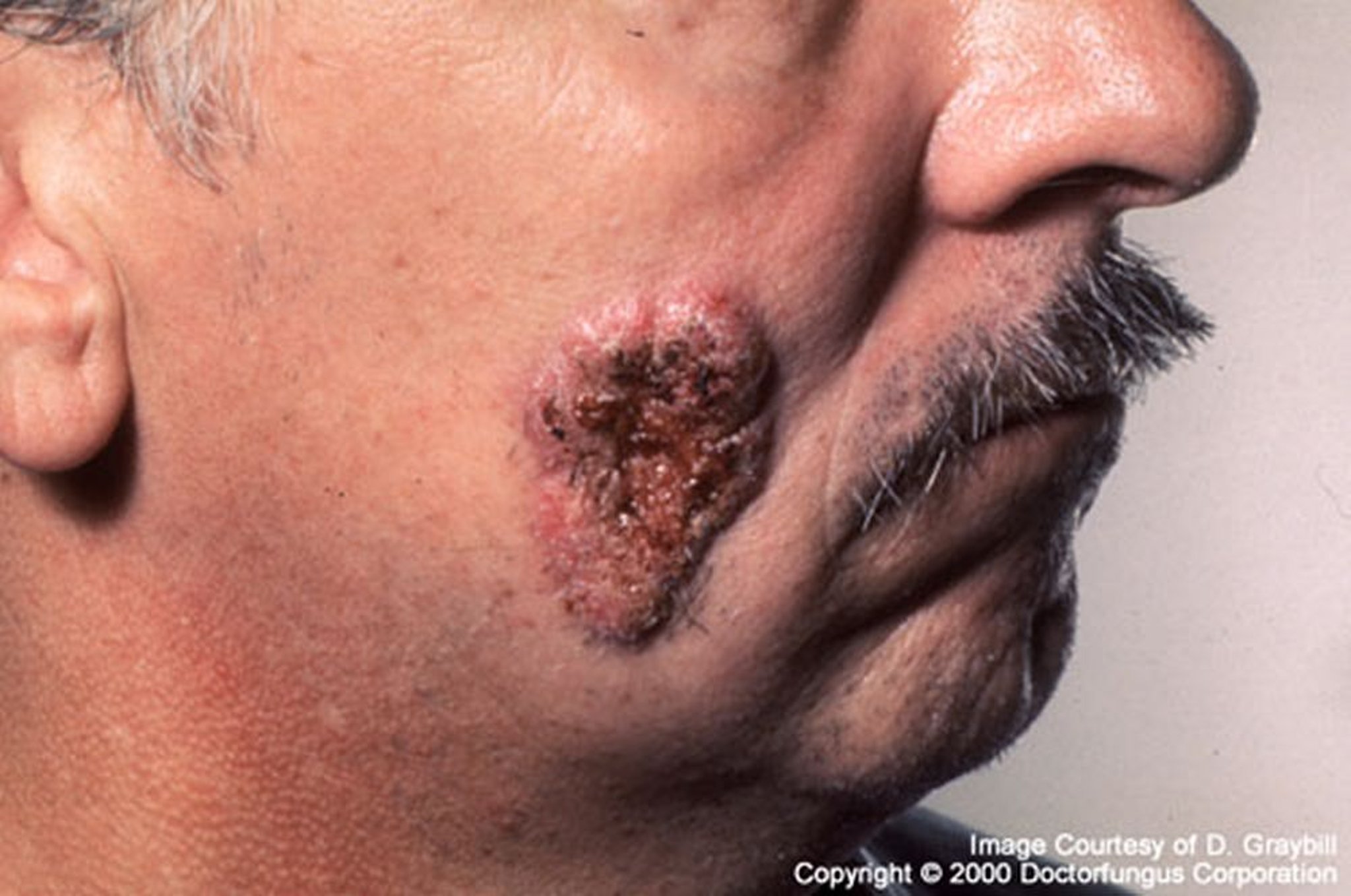 Blastomycose extrapulmonaire (aspect verruqueux)