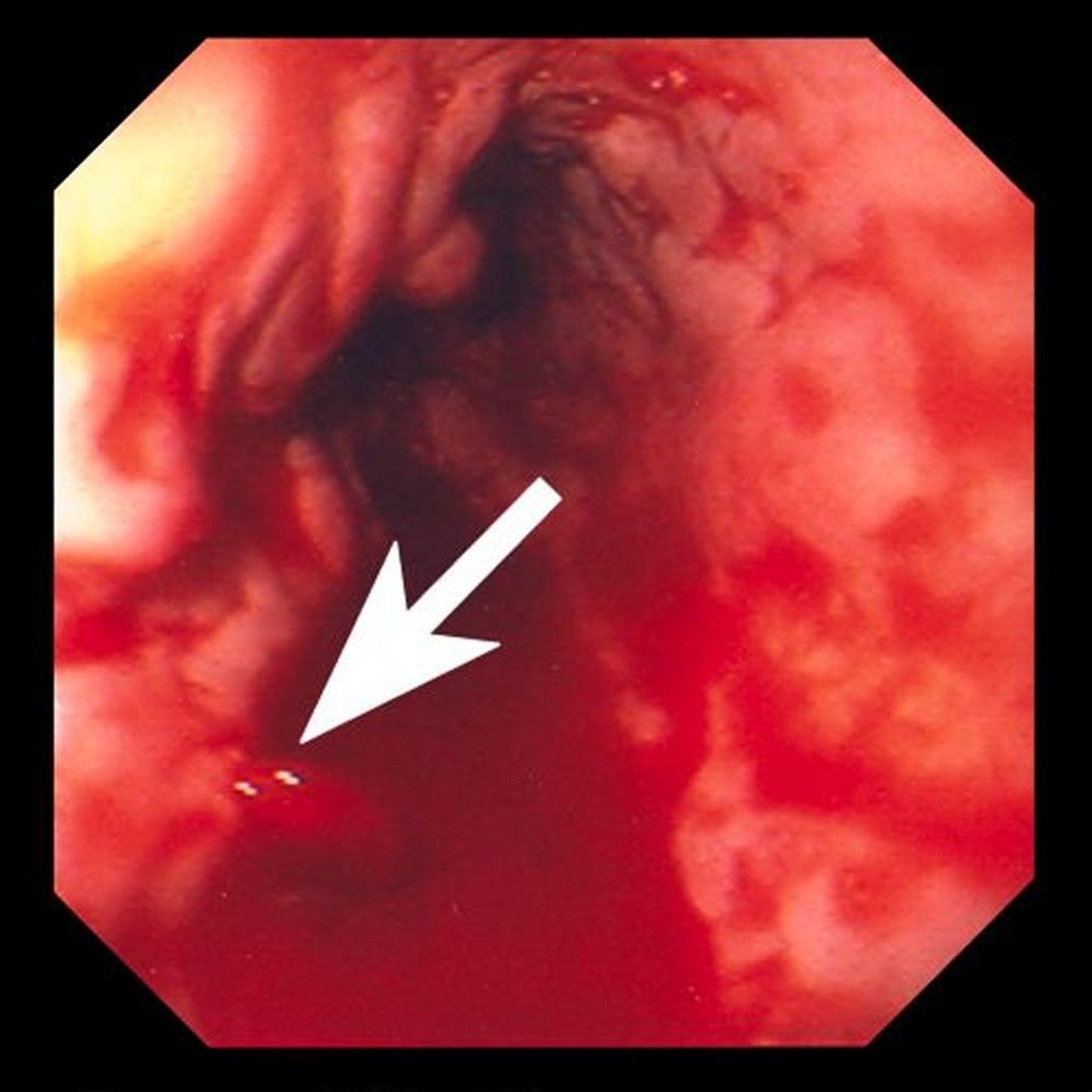 Bleeding Esophageal Varix