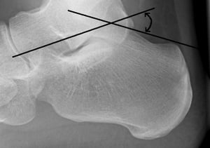 Angle de Bohler