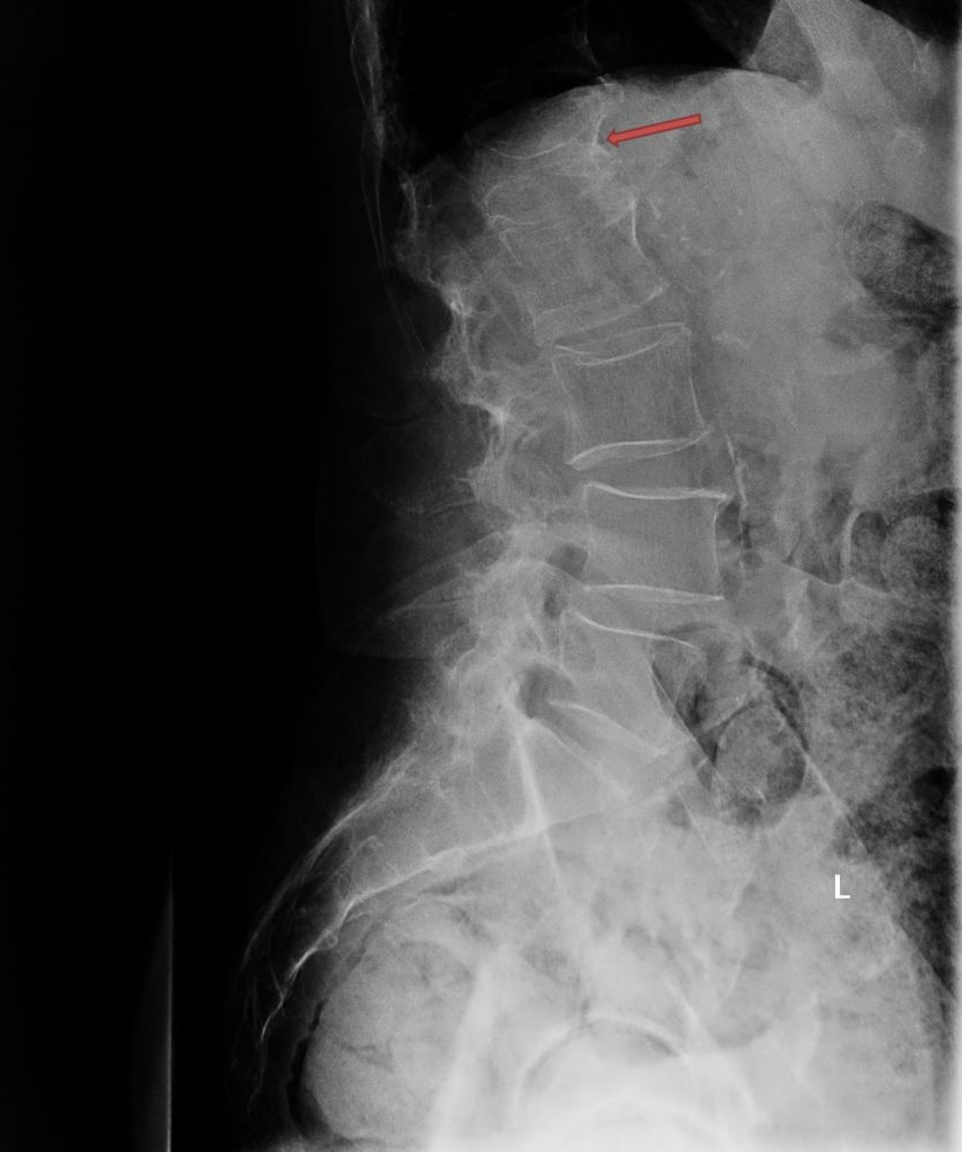 Fractura osteoporótica por compresión