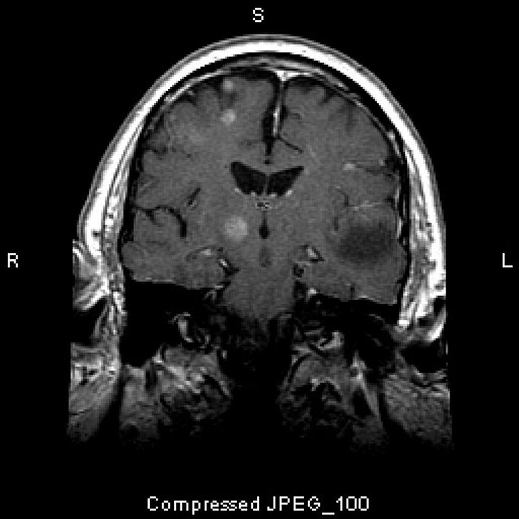 Metástasis cerebrales