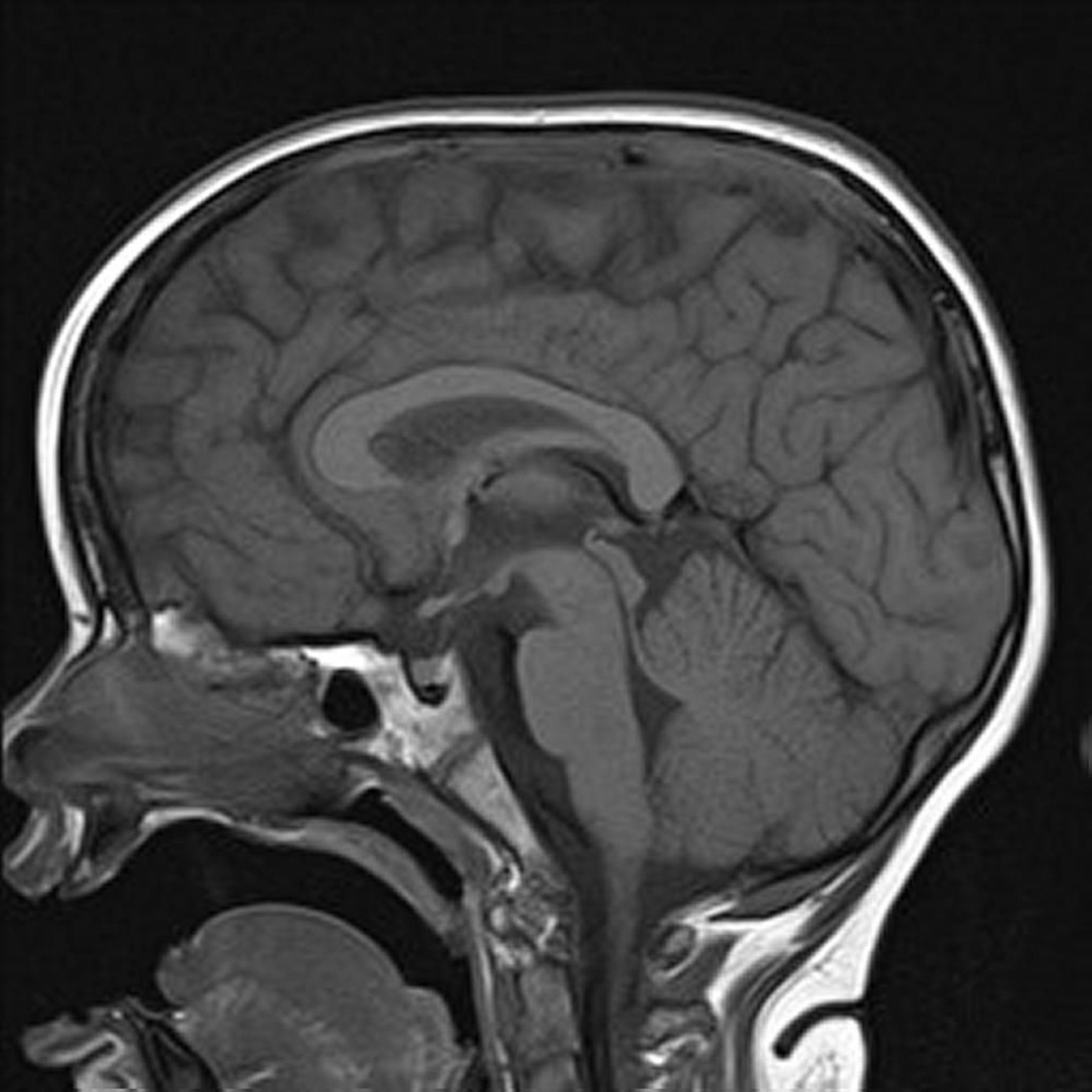 T1加权MRI