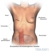 Brustrekonstruktion mit dem TRAM-Lappen (transversaler Rectus- abdominis-Muskel)