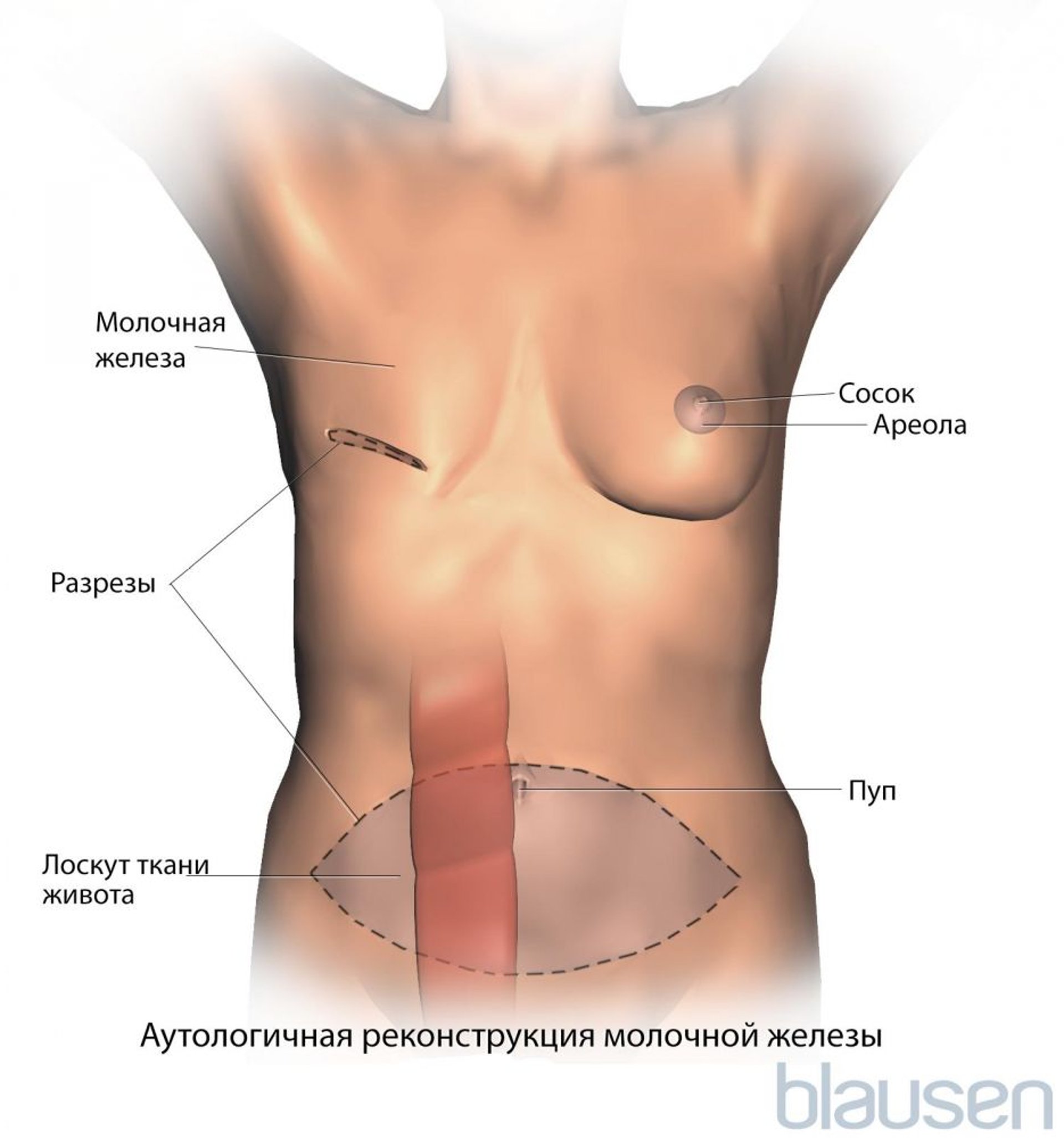Реконструкция груди с использованием лоскута поперечной прямой мышцы живота (TRAM)