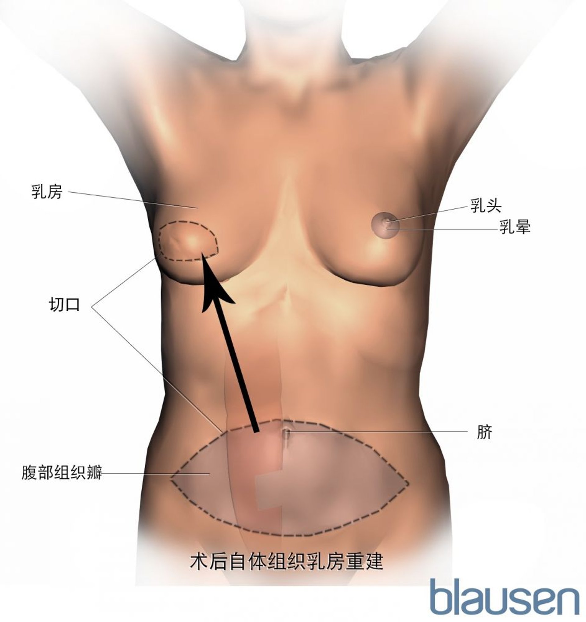 使用横腹直肌（TRAM）皮瓣重建乳房