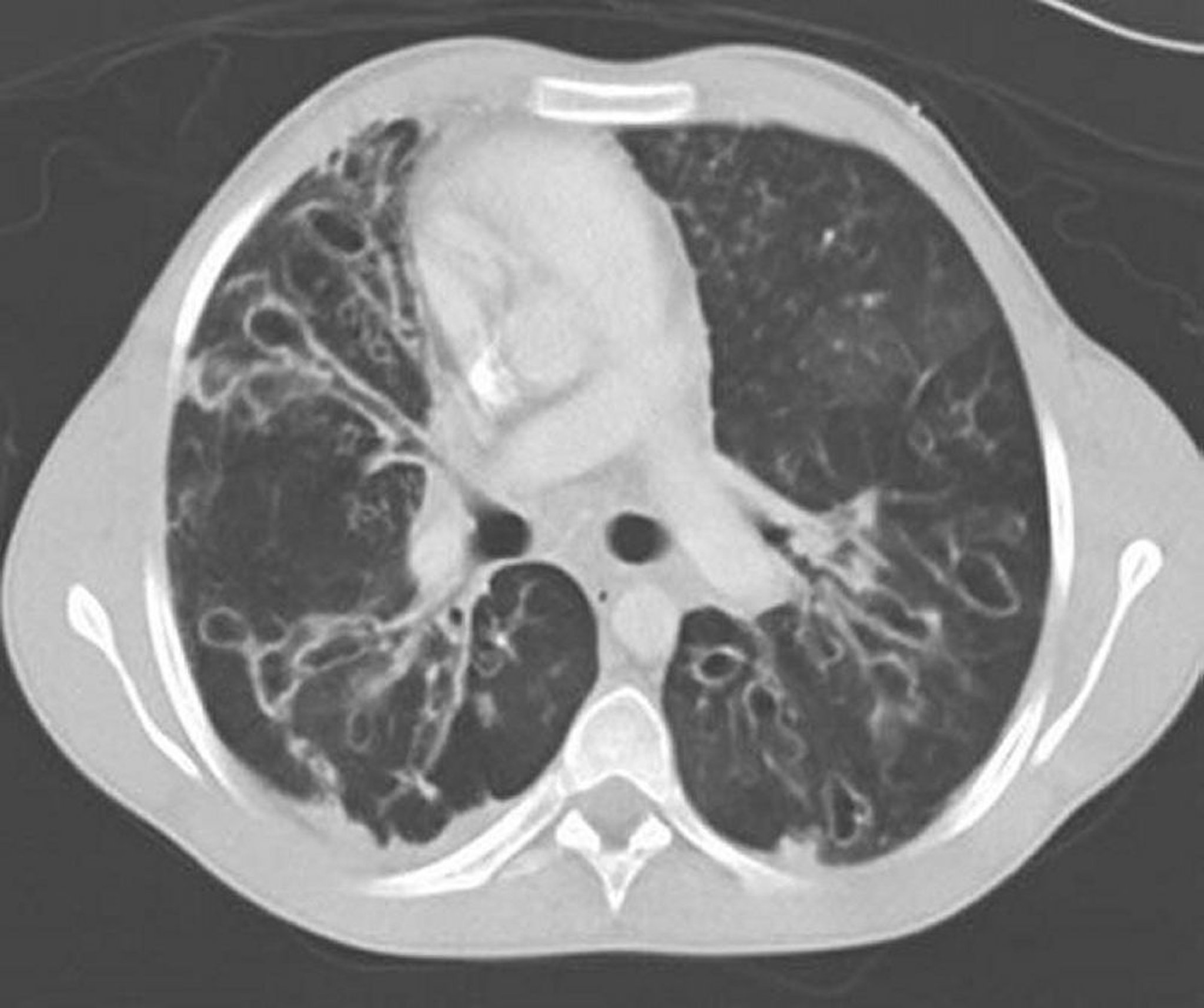 变态反应性支气管肺曲菌病（Bronchiectasis）