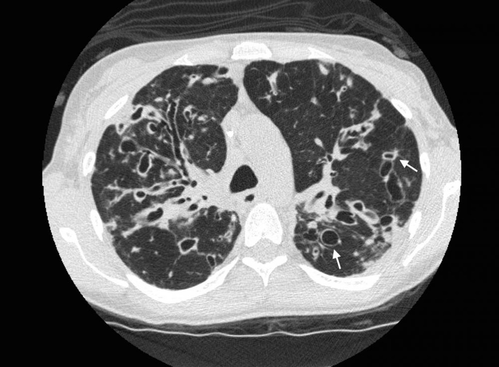 Bronquiectasia (tomografia computadorizada)