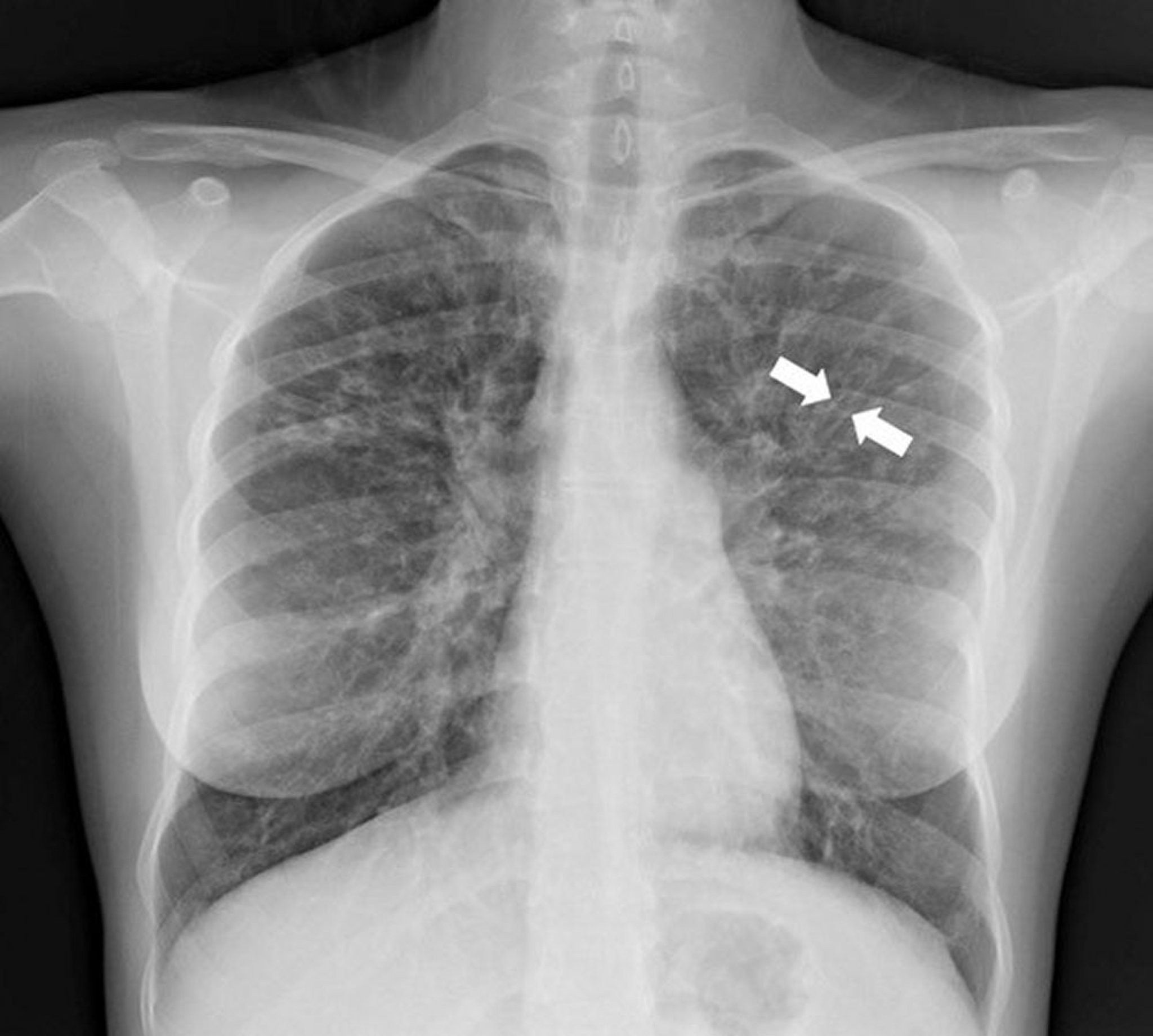 Bronchiectasis (X-Ray)