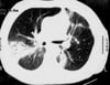 Pneumopathie cryptogénétique organisée