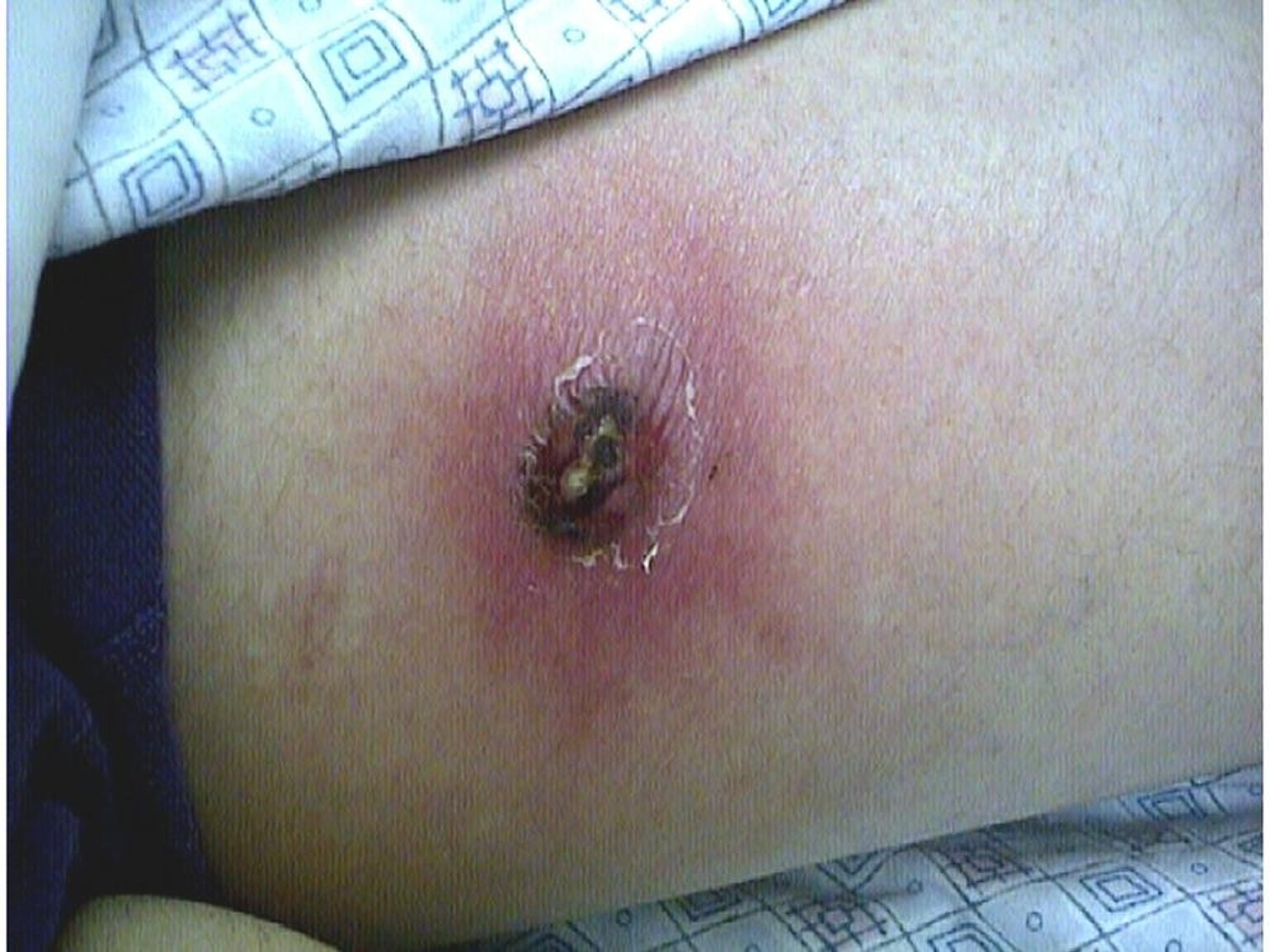 Brown Recluse Spider Bite