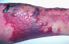 Erysipelas (Bullous)