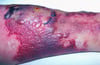 Erisipelas (ampollosas)