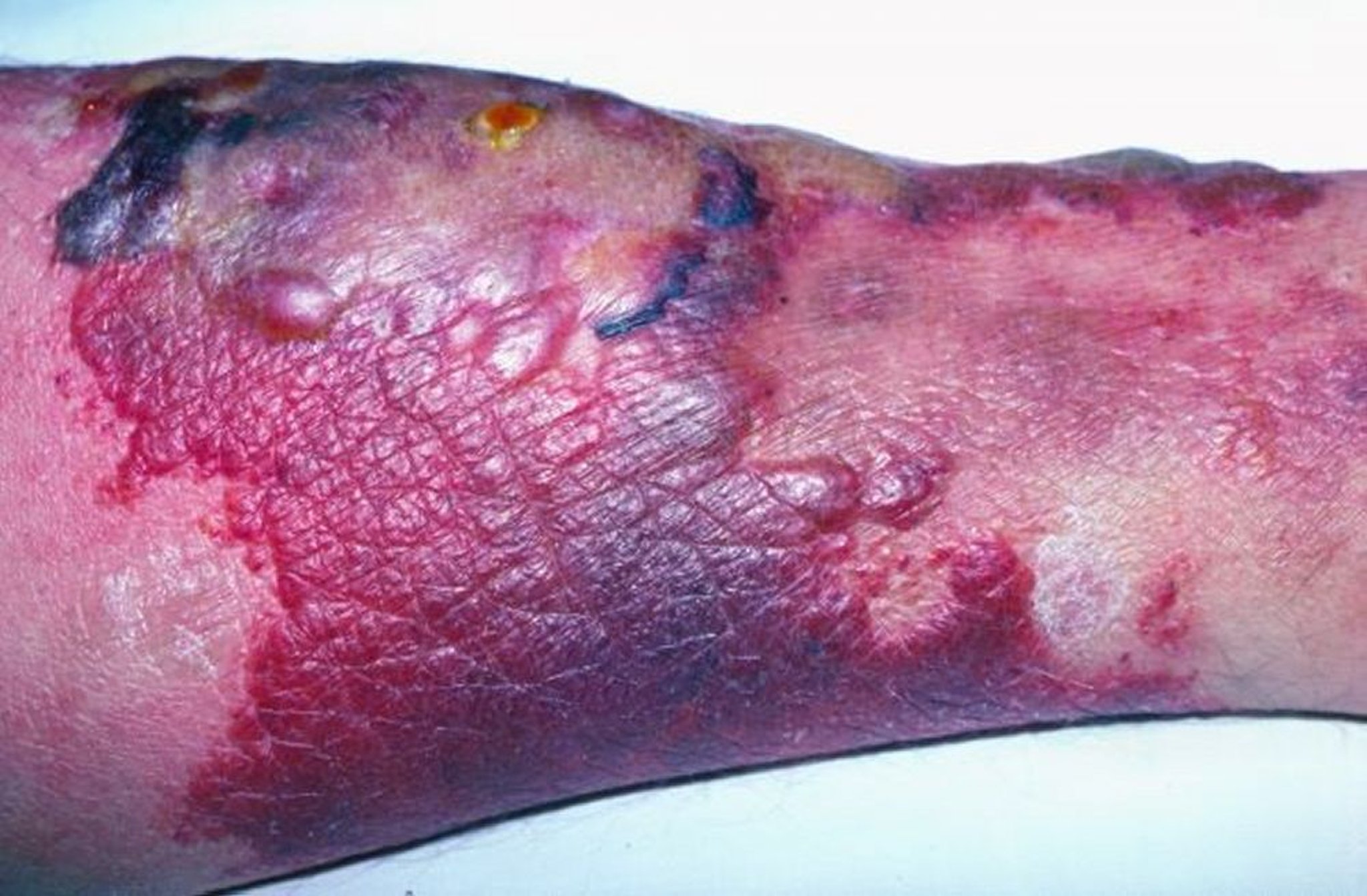 Erysipelas (Bullous)