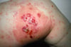Bullous Pemphigoid on the Thigh