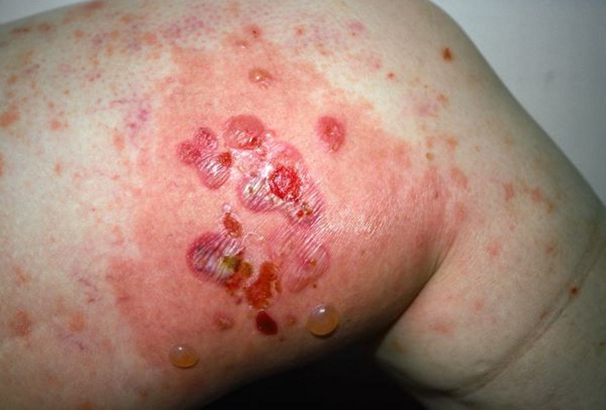 Pemphigoïde bulleuse sur la cuisse