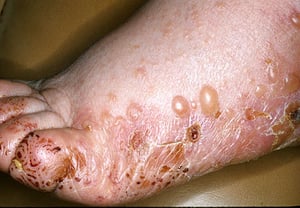 足に生じた水疱性類天疱瘡