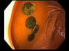 Pilas de botón en el ciego (endoscopia)
