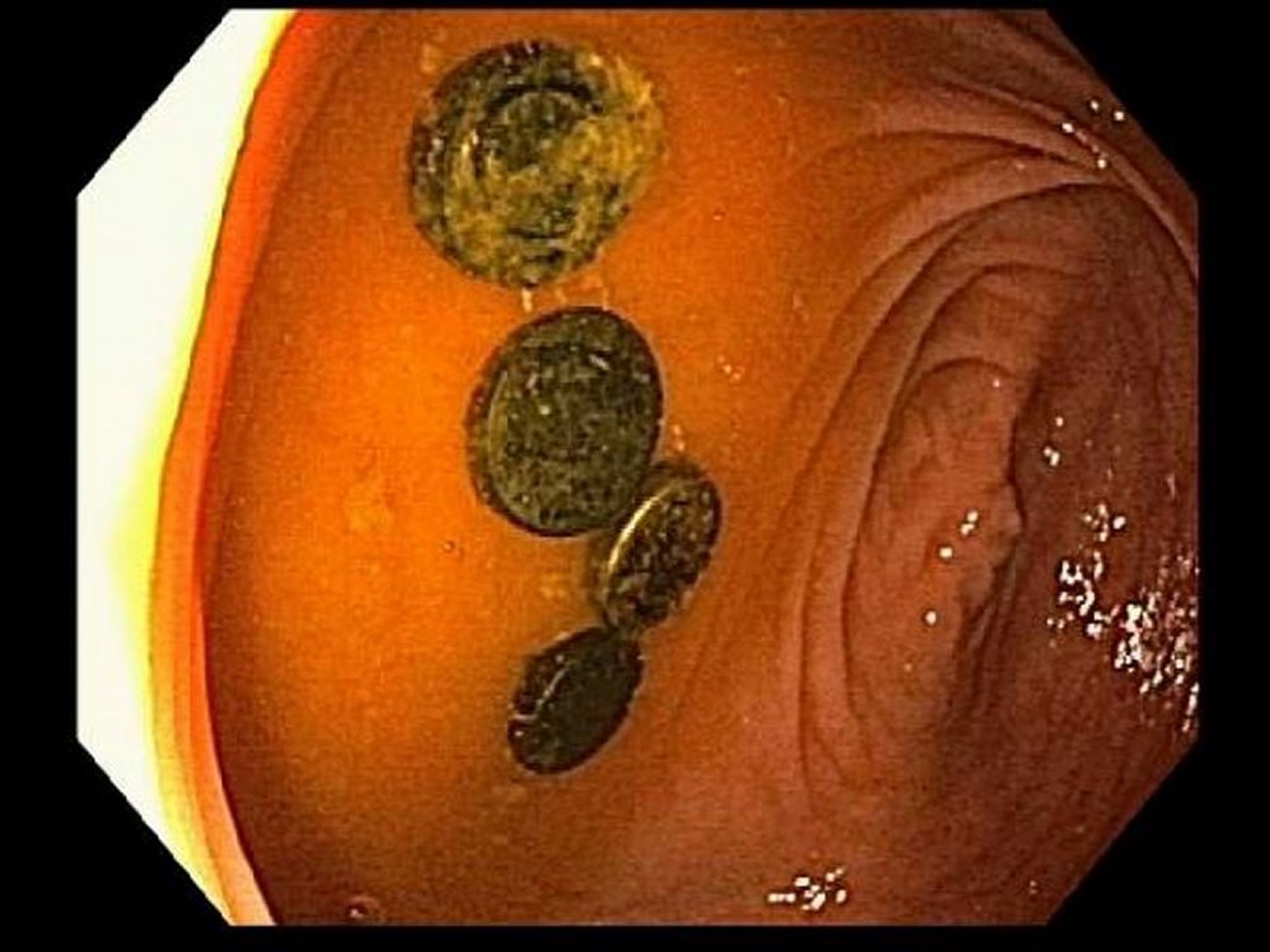 Piles bouton dans le caecum (endoscopie)