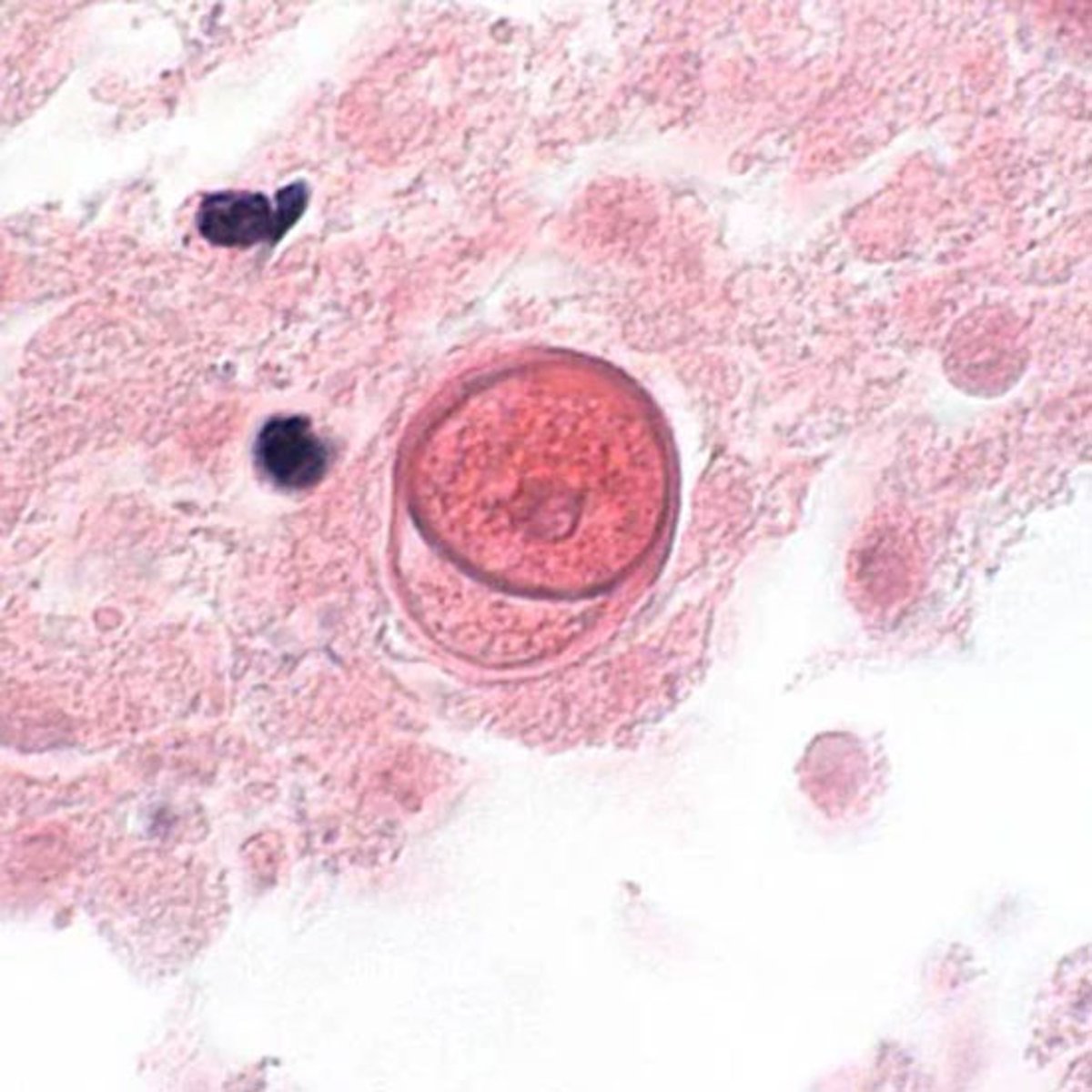 <i >Balamuthia mandrillaris</i> Cyst in Brain Tissue