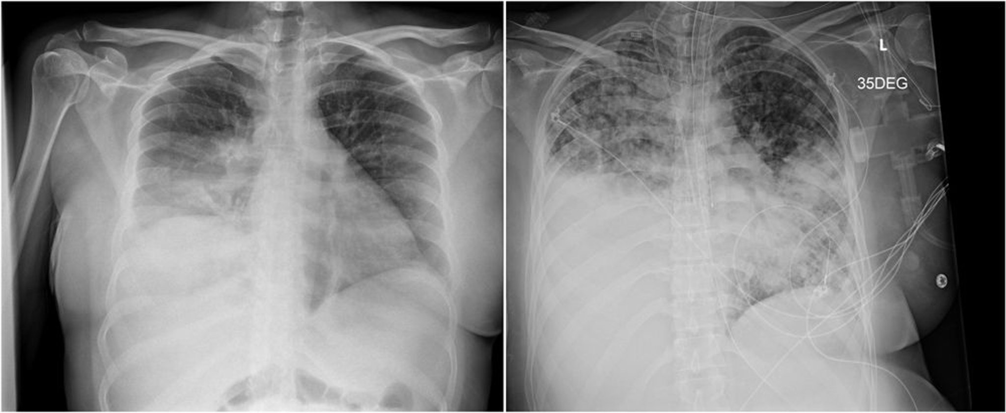 Blastomycosis (Radiographs)