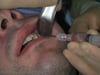 Needle Aspiration of Dental Abscess