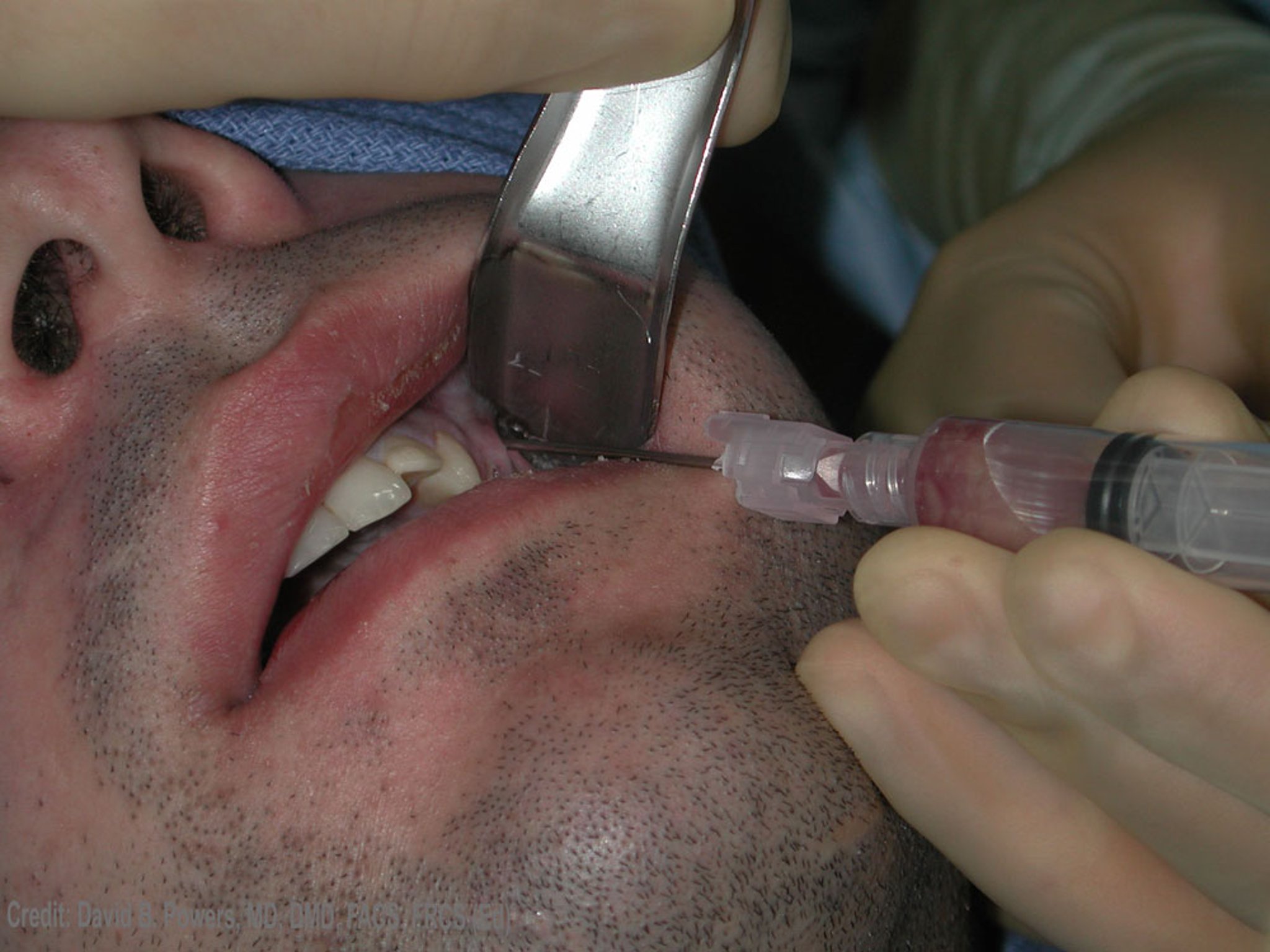 Needle Aspiration of Dental Abscess