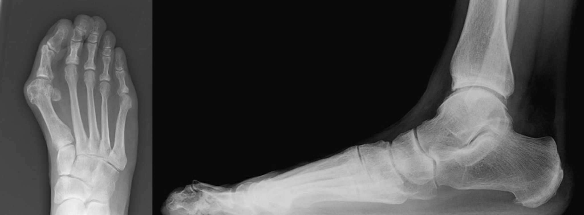 Bunion with Hammertoe Radiographs