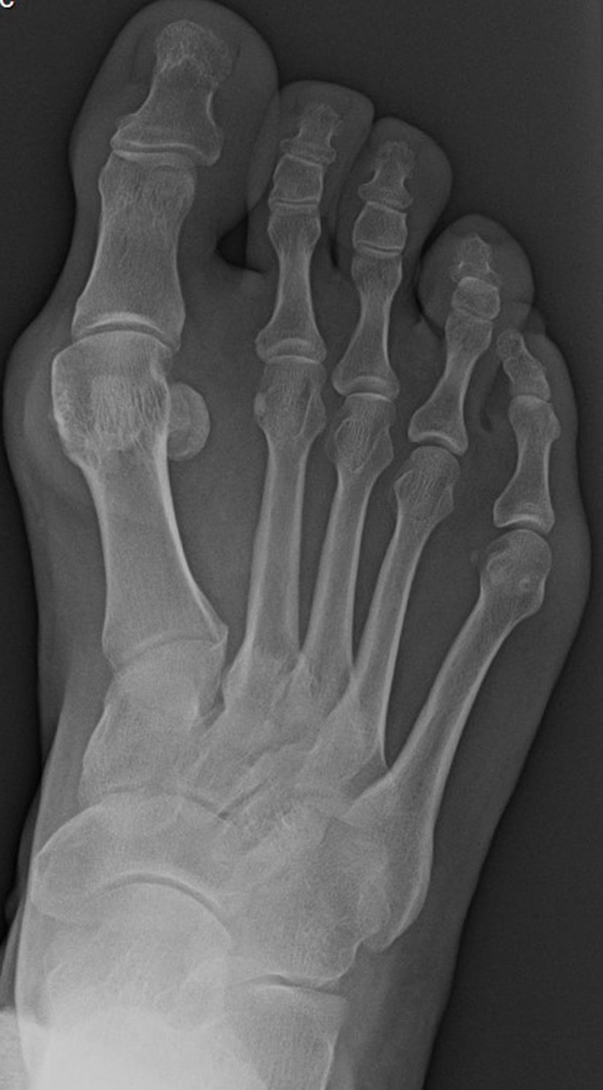 Anteroposteriores (AP) Röntgenbild eines Fußes mit Hallux valgus