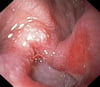 Úlcera duodenal