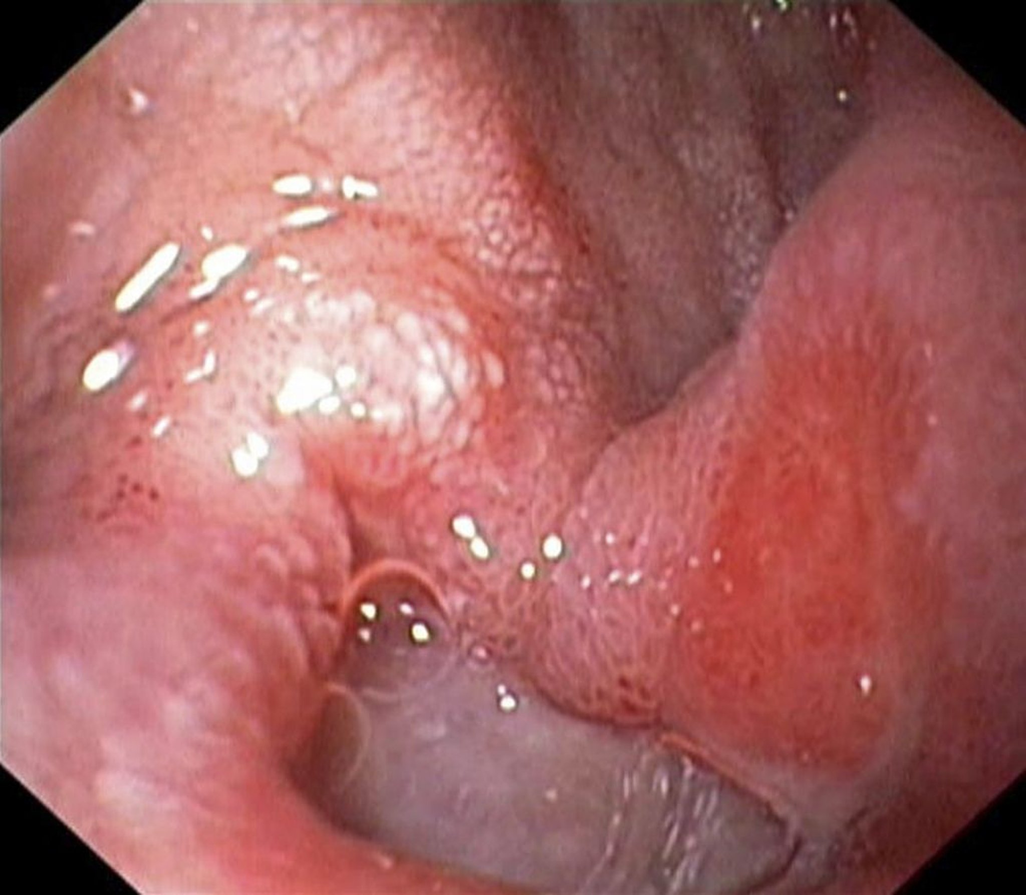 Úlcera duodenal