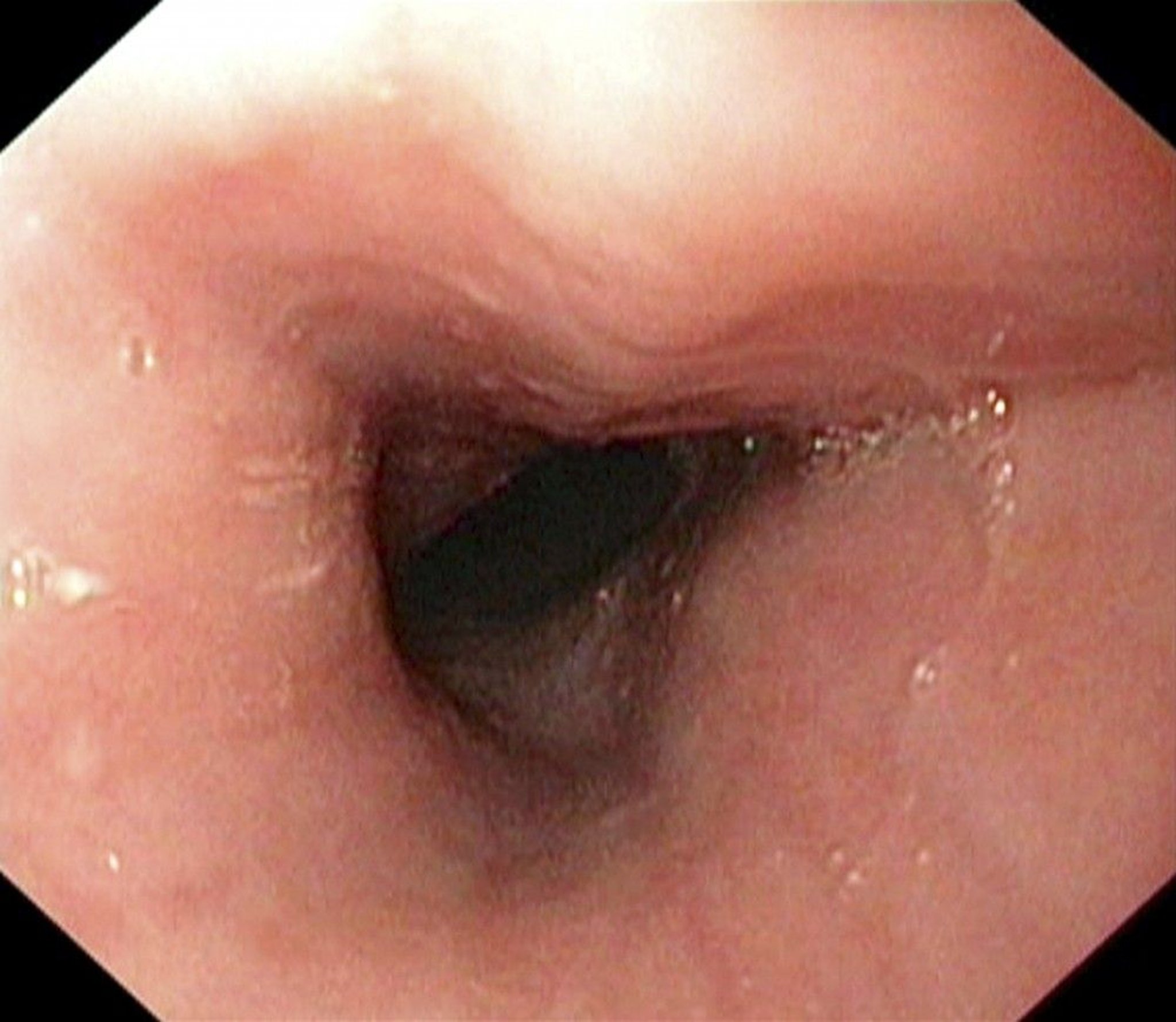 Endoscopy (Esophagus)