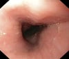 Endoscopie (œsophage)