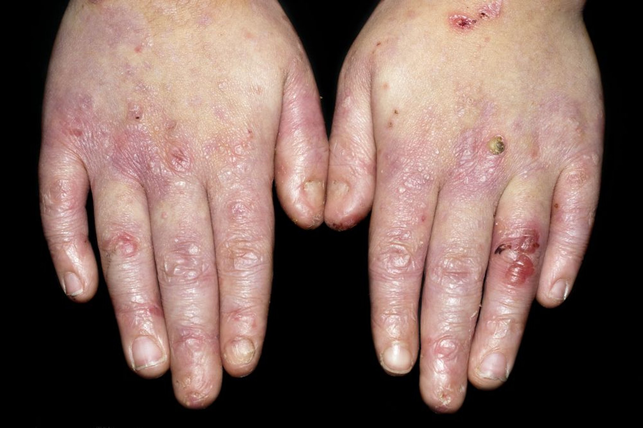 Epidermólise bolhosa (Mãos)