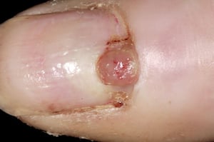 Granulome pyogénique (ongle)