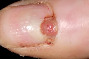 化膿性肉芽腫（爪）