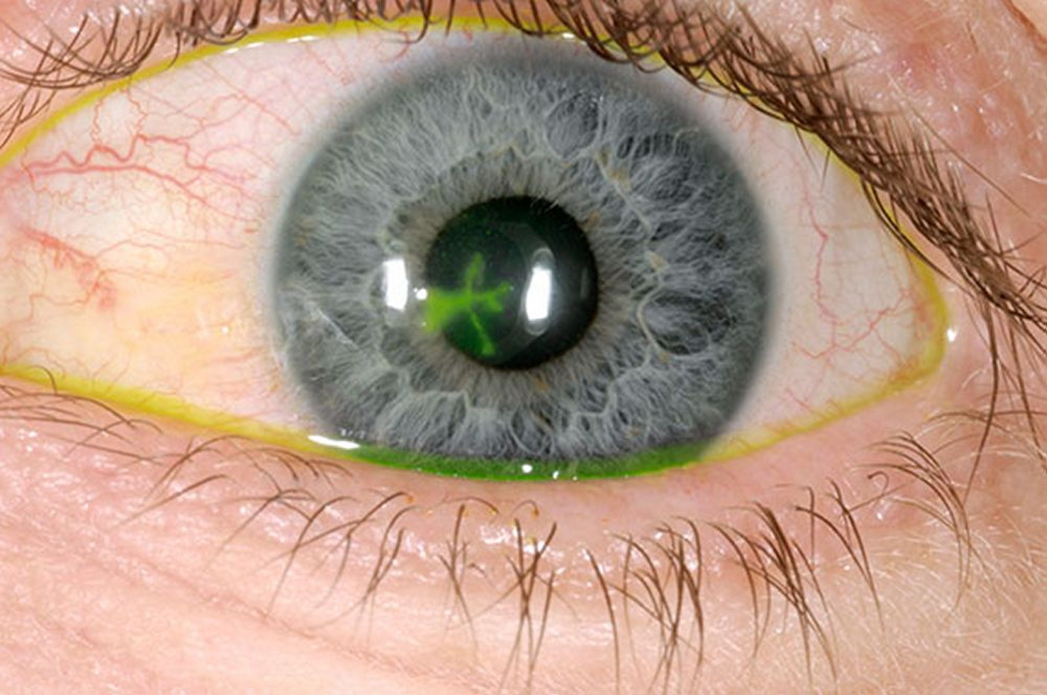Herpes-simplex-Keratitis (dendritische Keratitis)