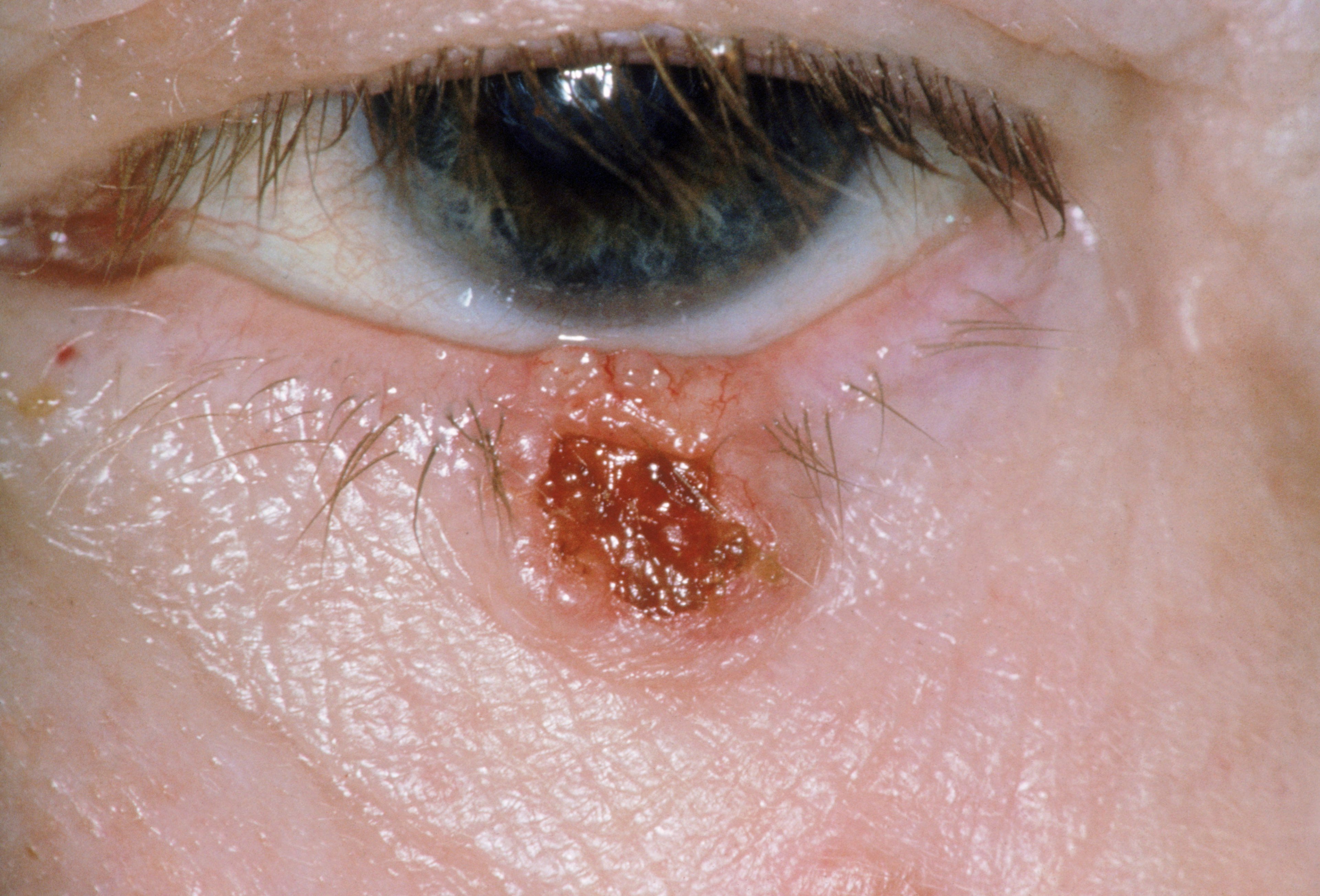 眼瞼の基底細胞癌