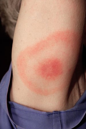 Eritema migrante nella malattia di Lyme (rash a occhio di bue)