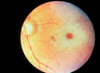 Mancha macular rojo cereza