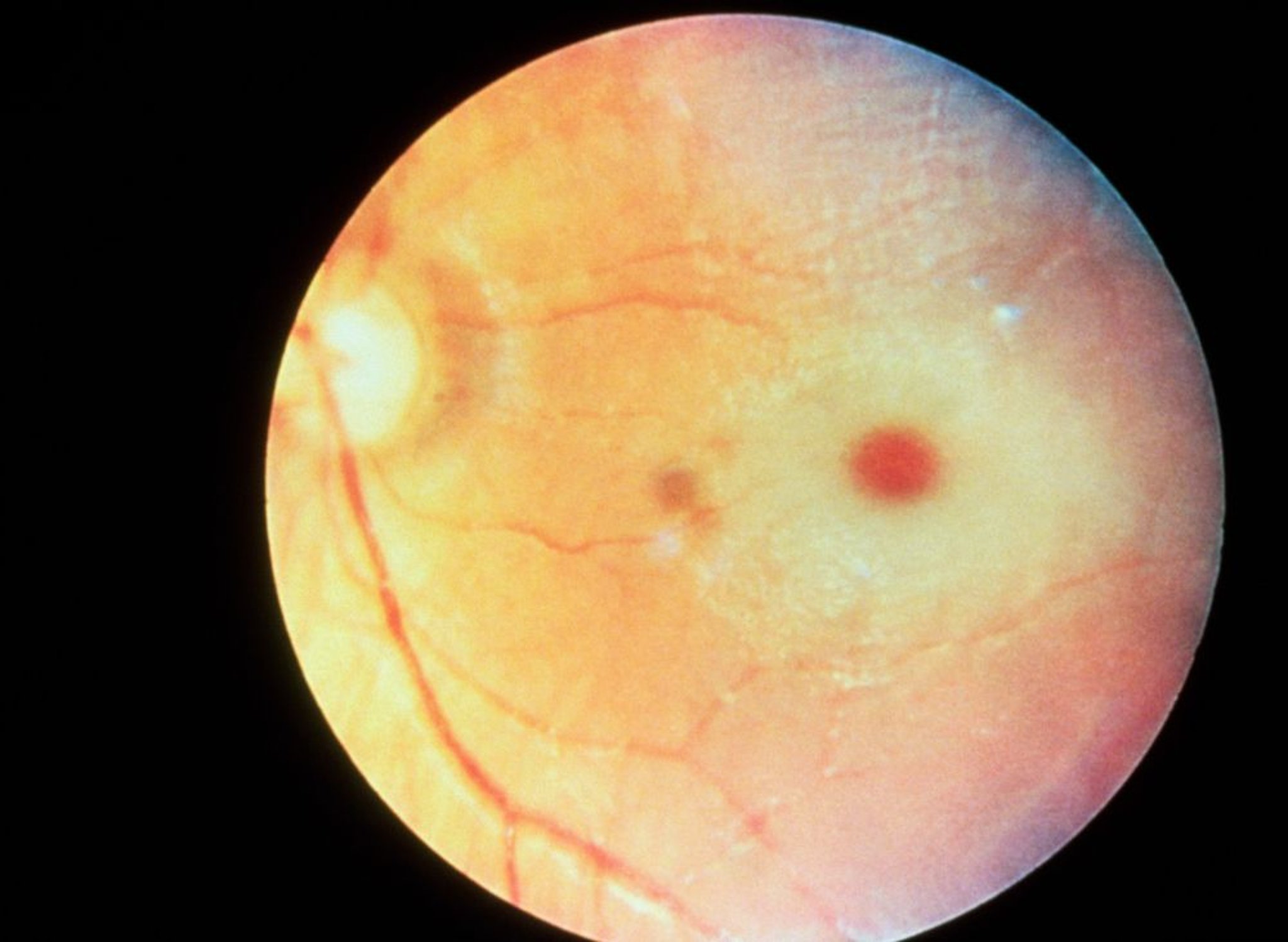 Mancha macular vermelho-cereja