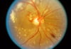 Retinopatía hipertensiva (moderada)