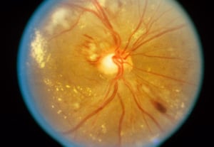 Rétinopathie hypertensive (modérée)